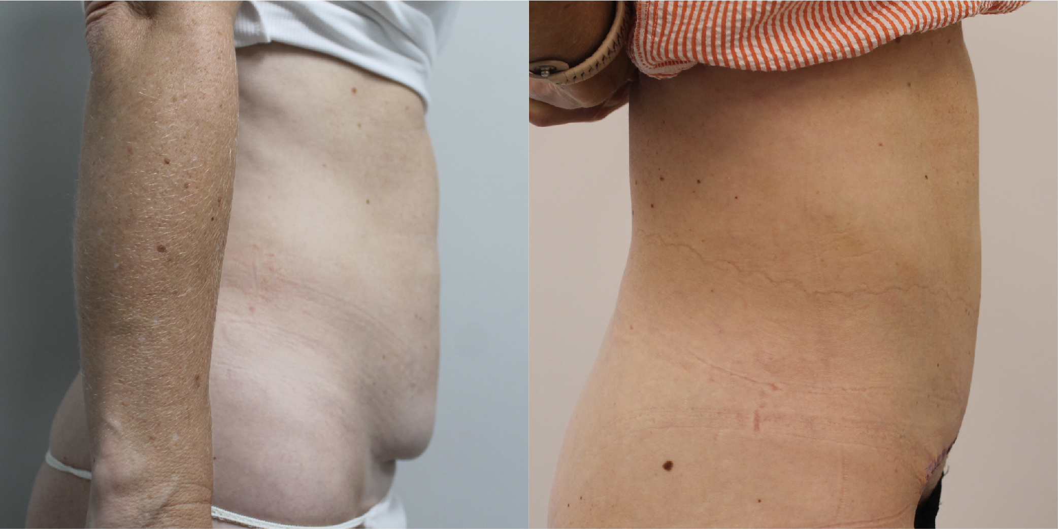 BodyTite Before & After Image
