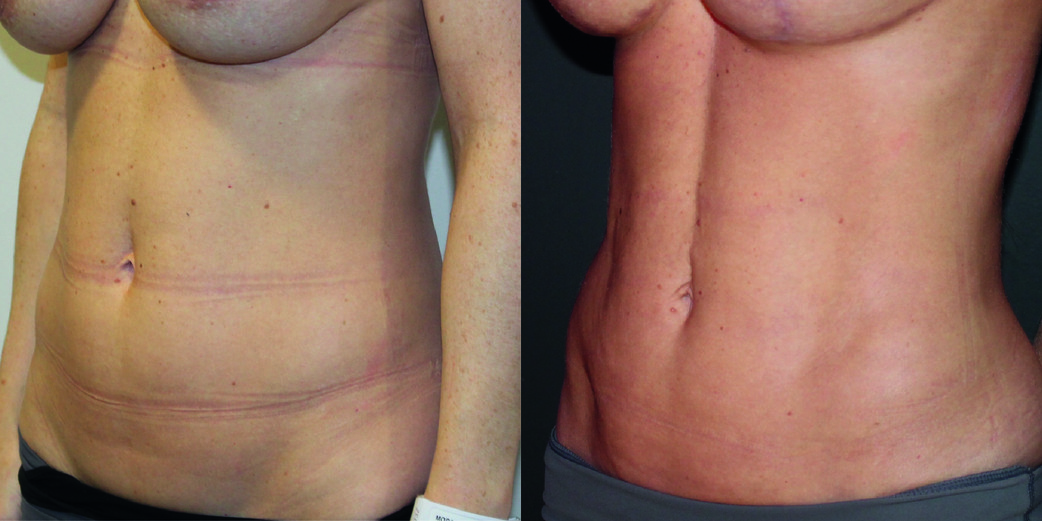 Vaser Liposuction Before & After Image