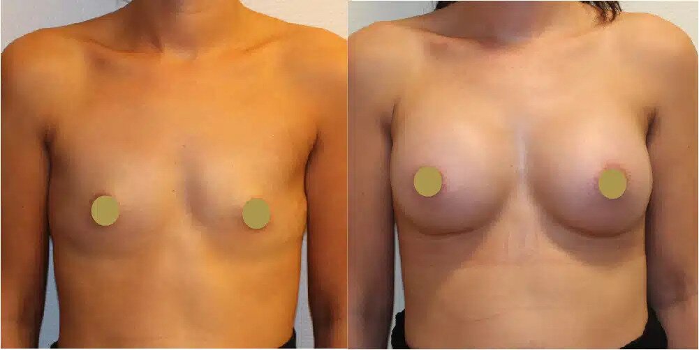 Boob Job Before & After Image