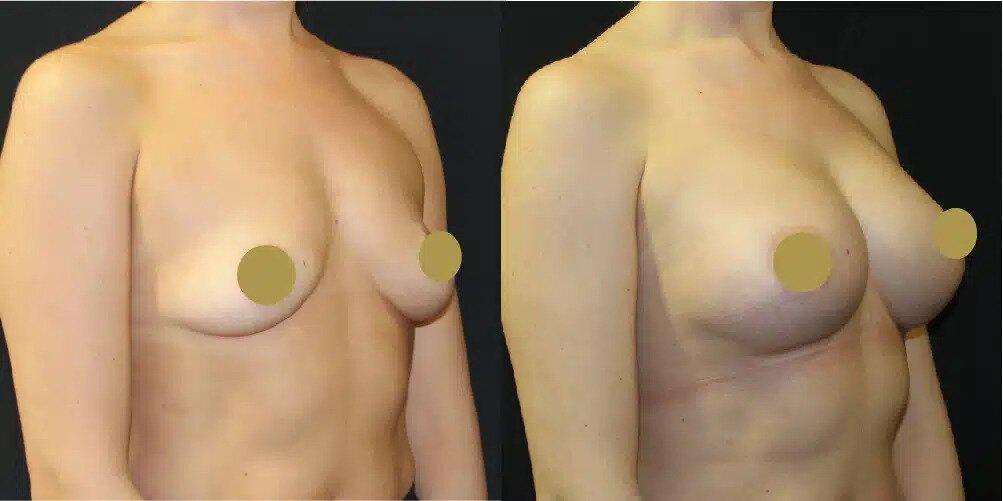 Boob Job Before & After Image