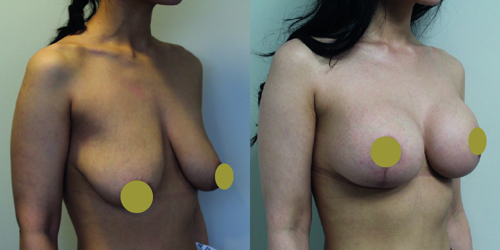 Breast Augmentation Mastopexy Before & After Image