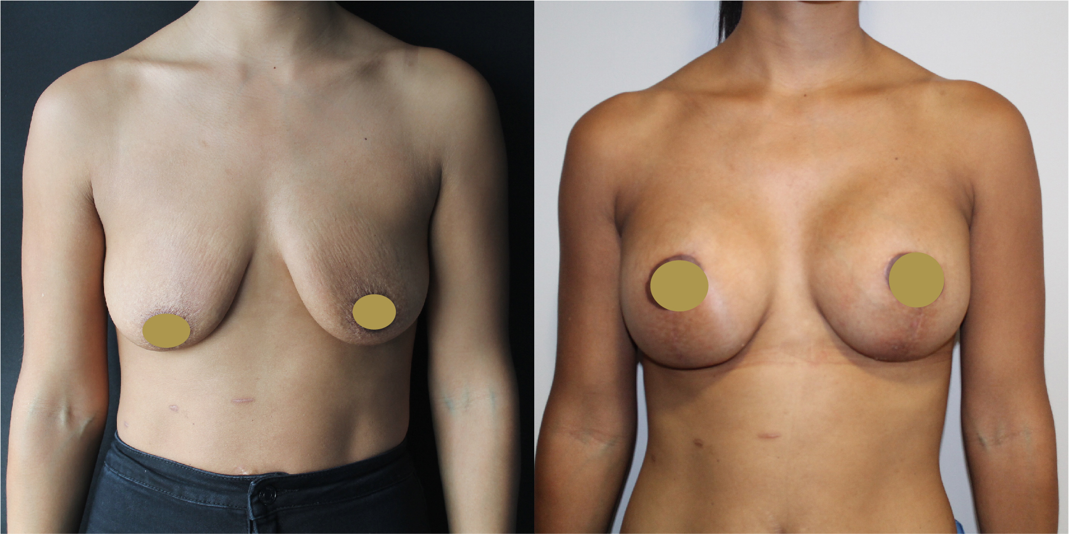 Breast Augmentation Mastopexy Before & After Image
