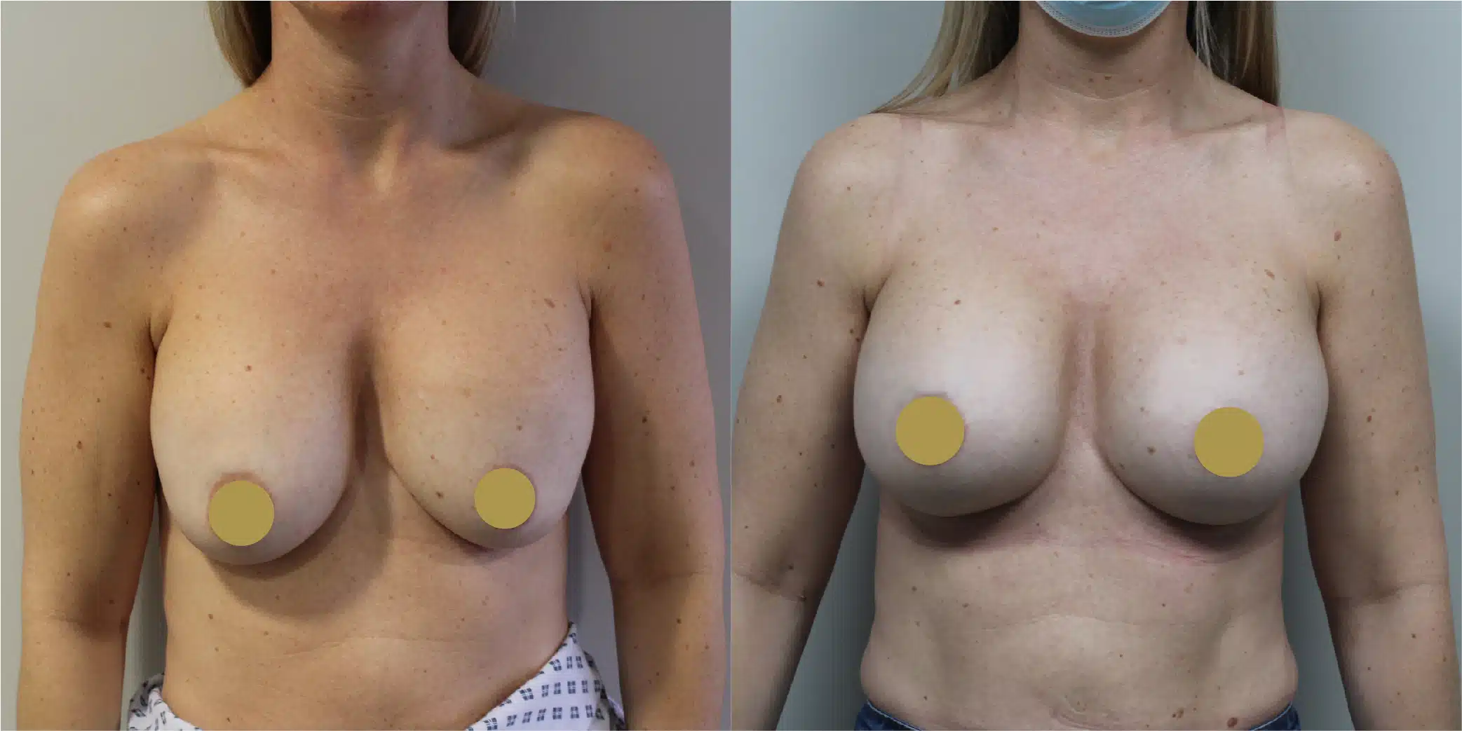 Breast Implant Exchange Before & After Image