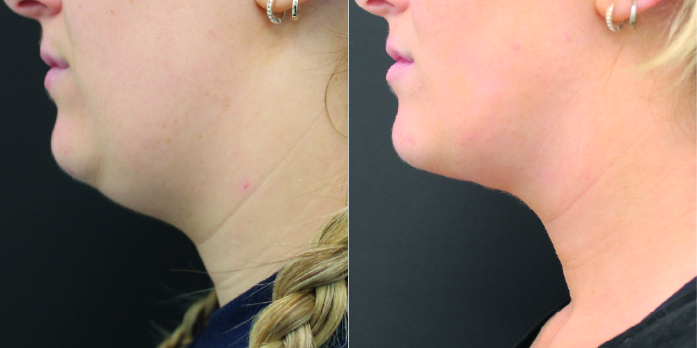 Double Chin Liposuction Before & After Image