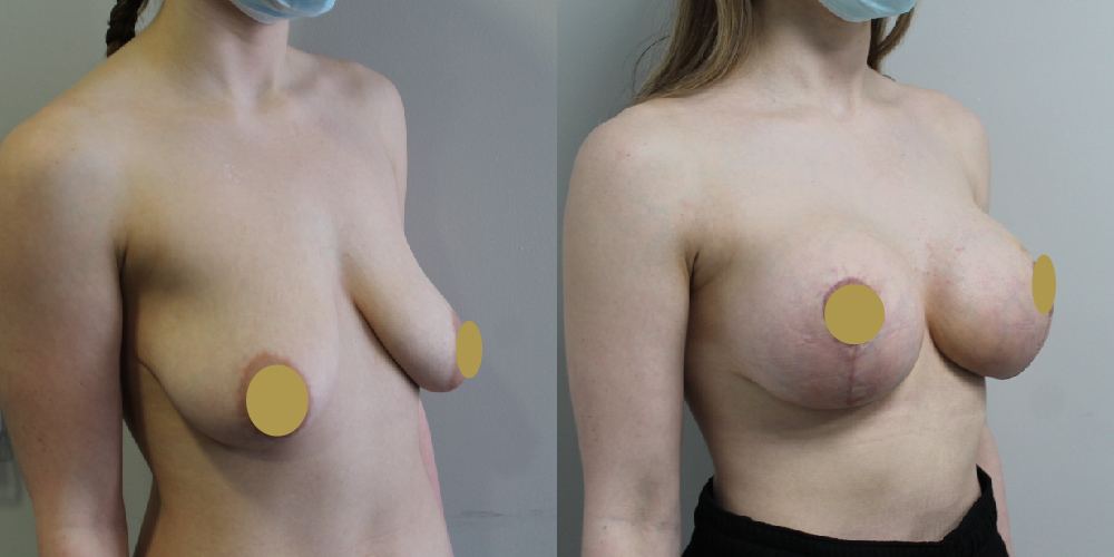 Augmentation Mastopexy before and after