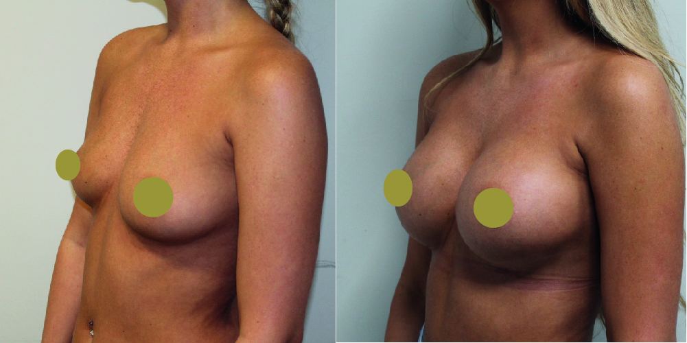 breast augmentation before and after 300cc high profile dual plane