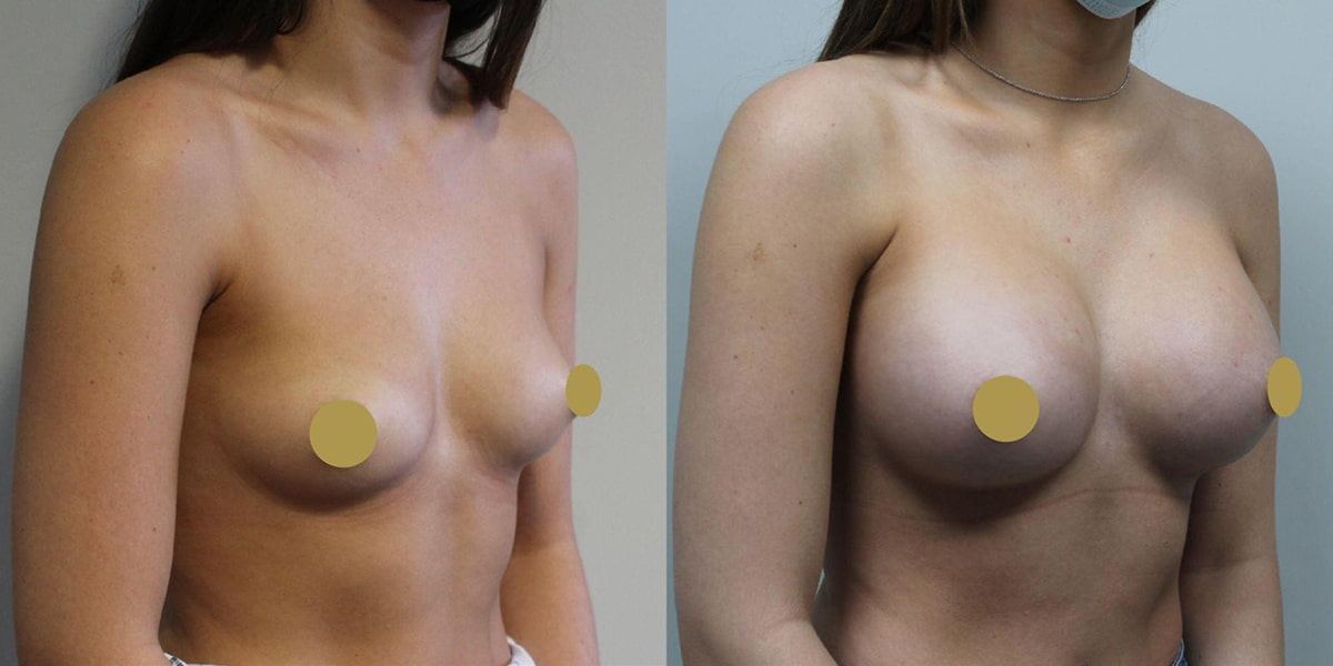 mentor-breast-implants-before-and-afters gummy bear