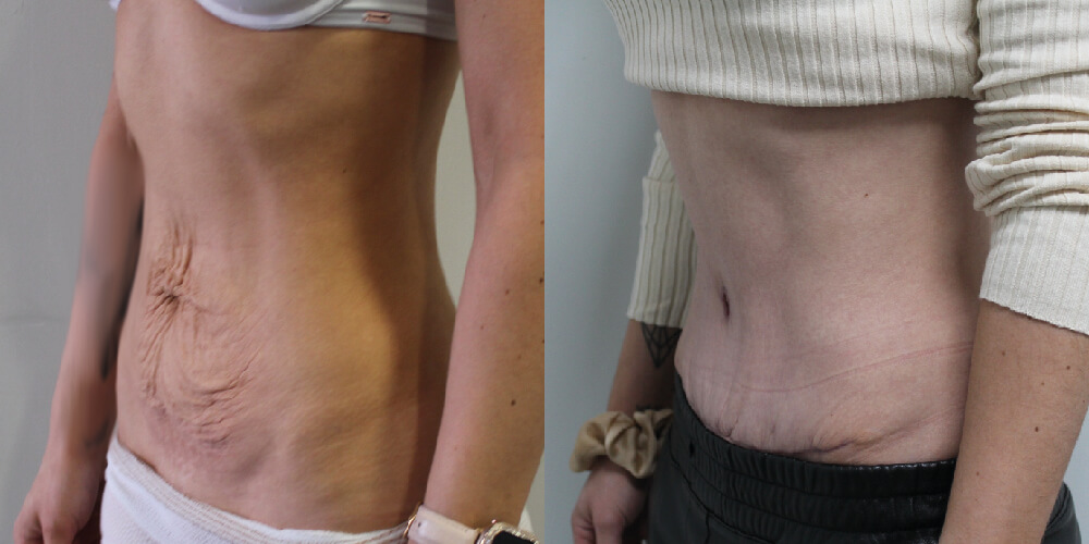 Abdominoplasty Before & After Image