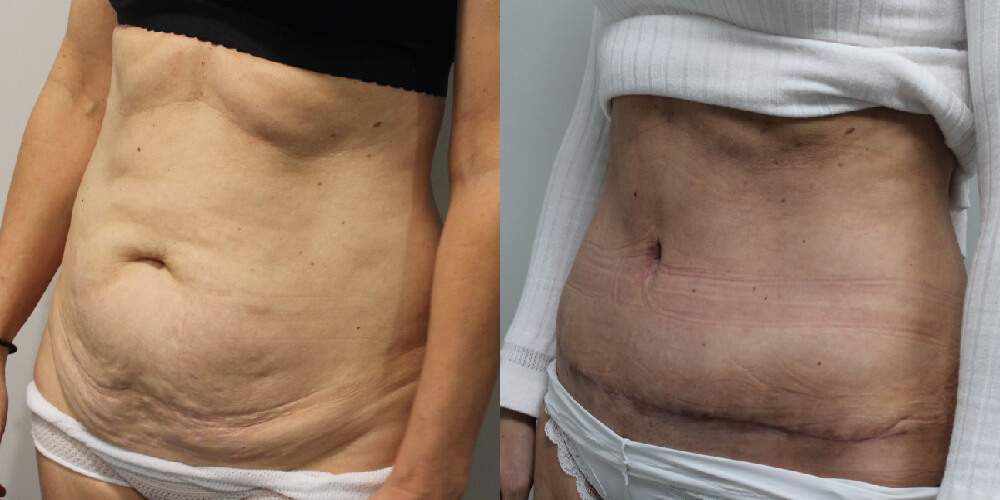 Abdominoplasty Before & After Image