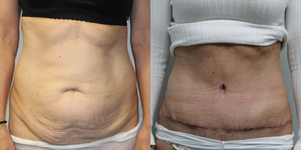 Abdominoplasty Before & After Image