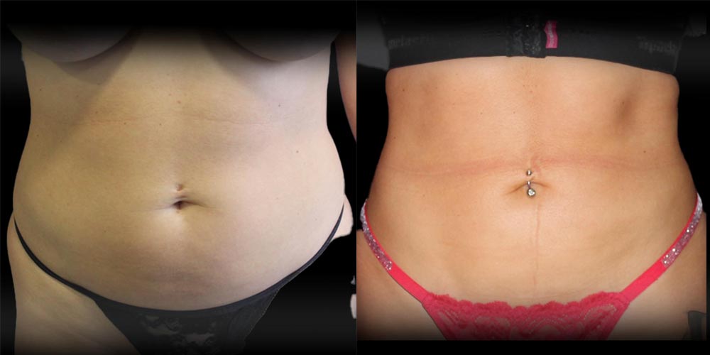 Liposuction Before & After Image