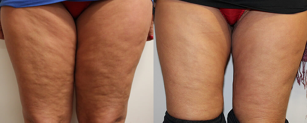 Liposuction Before & After Image