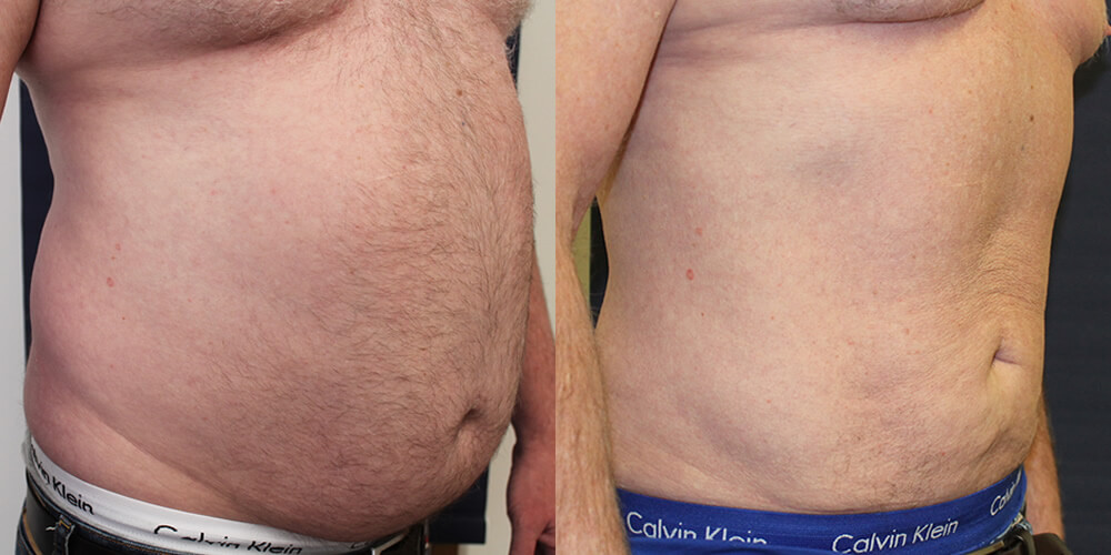 Liposuction Before & After Image