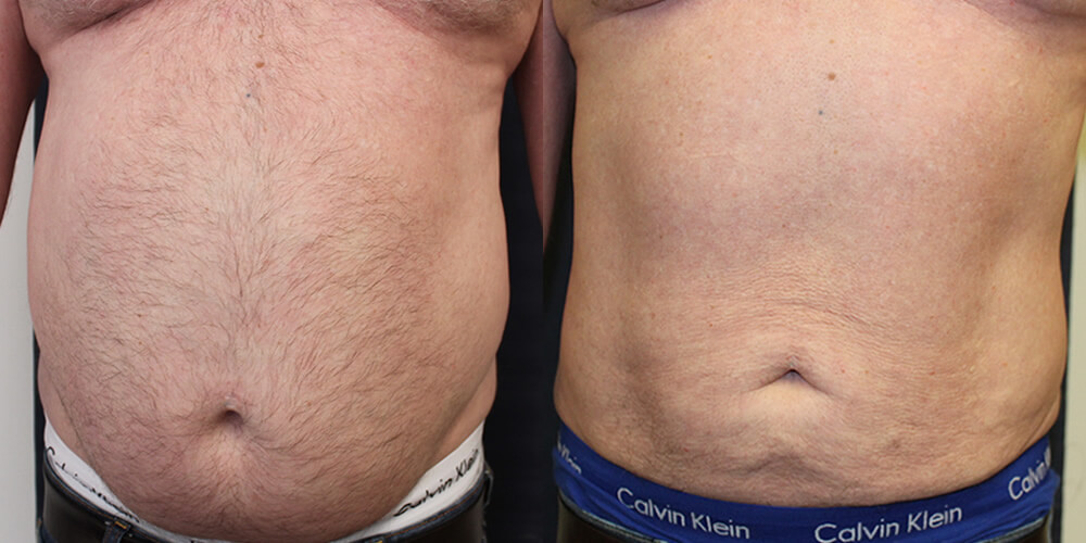 Liposuction Before & After Image