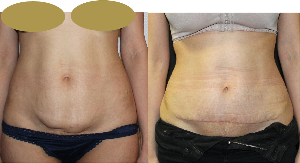 Mini Tummy Tuck Before & After Image