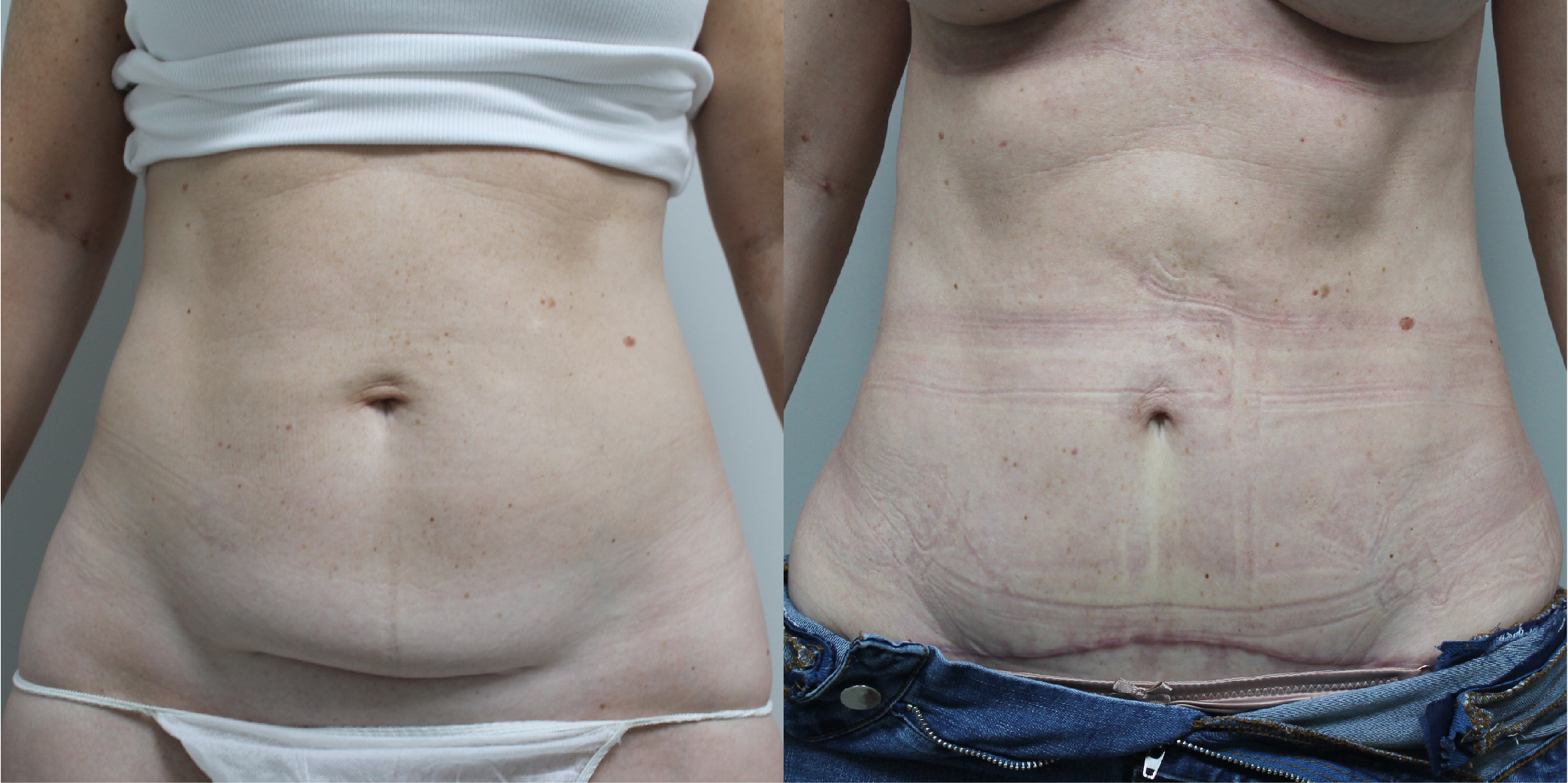 Mini Tummy Tuck Before & After Image