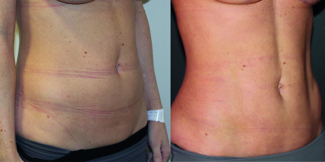 Vaser Liposuction Before & After Image