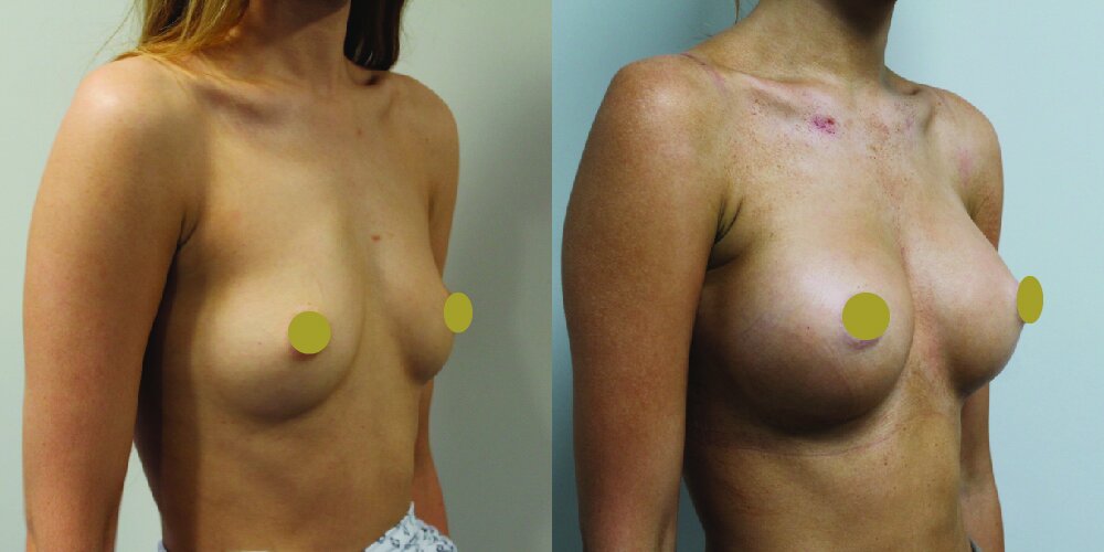 Boob Job Before & After Image