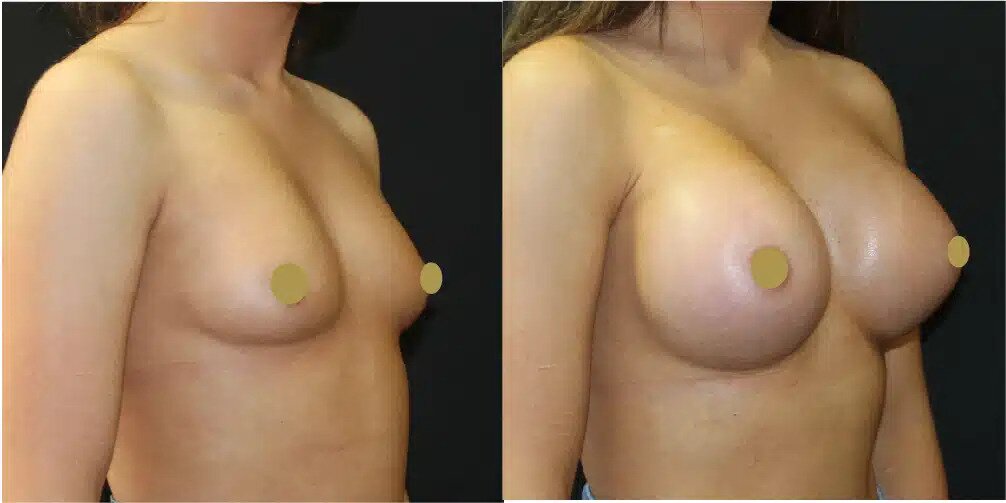 Boob Job Before & After Image