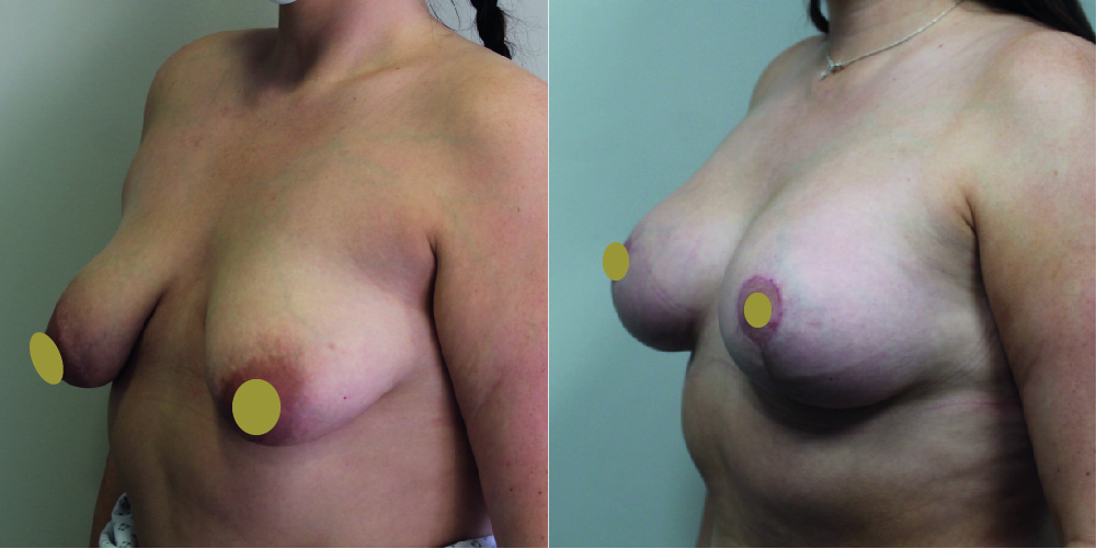 Breast Augmentation Mastopexy Before & After Image