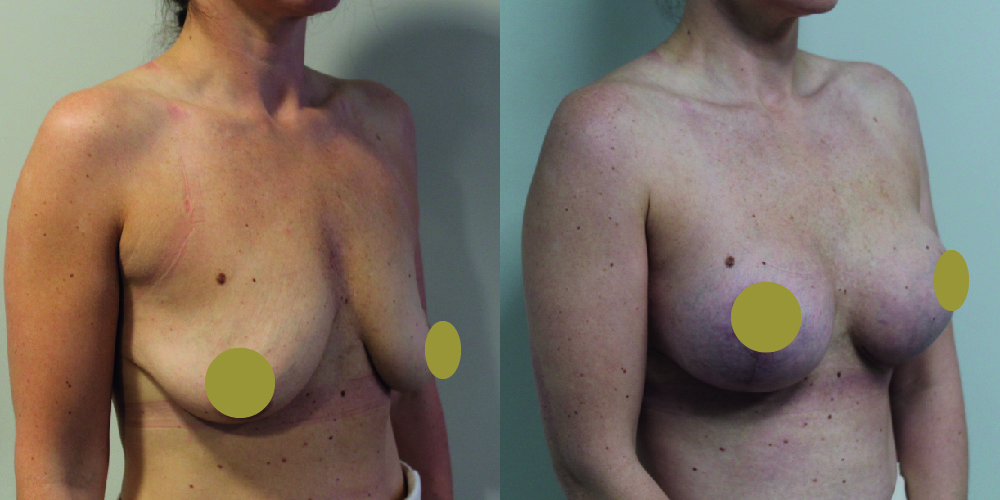 Breast Augmentation Mastopexy Before & After Image