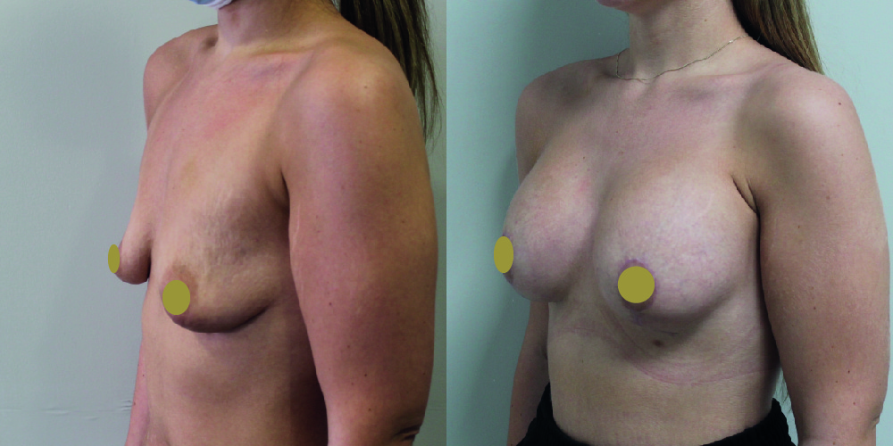 Breast Augmentation Mastopexy Before & After Image