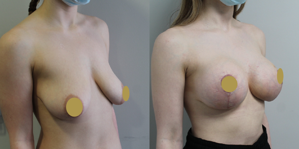 Breast Augmentation Mastopexy Before & After Image