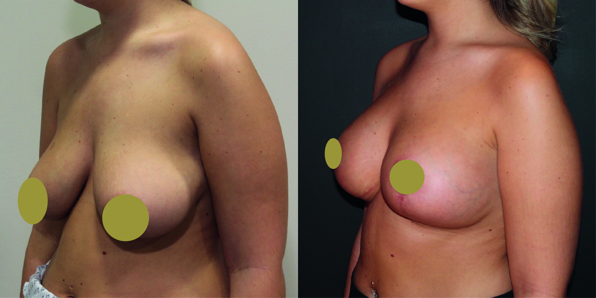 Breast Augmentation Mastopexy Before & After Image