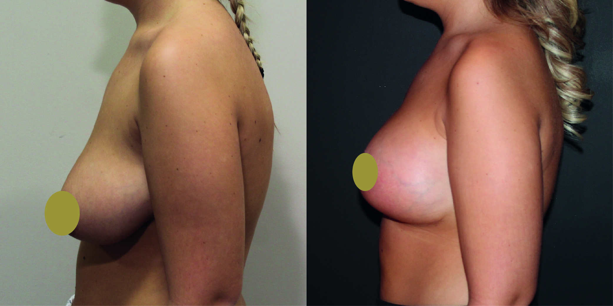 Breast Augmentation Mastopexy Before & After Image