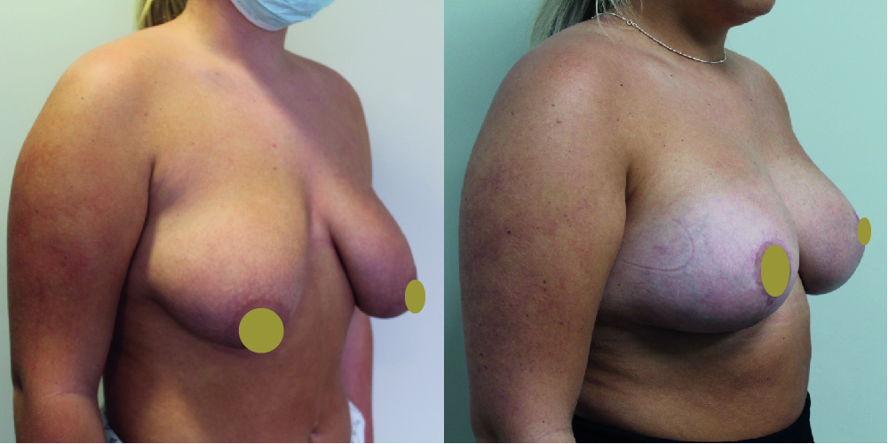 Breast Augmentation Mastopexy Before & After Image