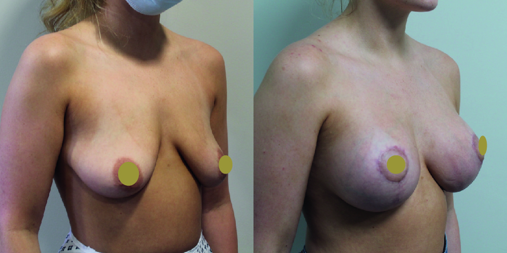 Breast Augmentation Mastopexy Before & After Image