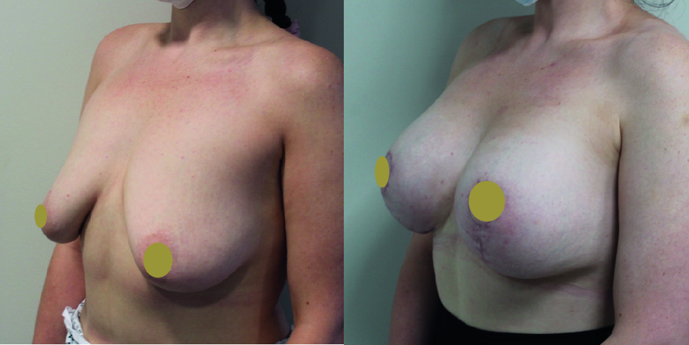 Breast Augmentation Mastopexy Before & After Image