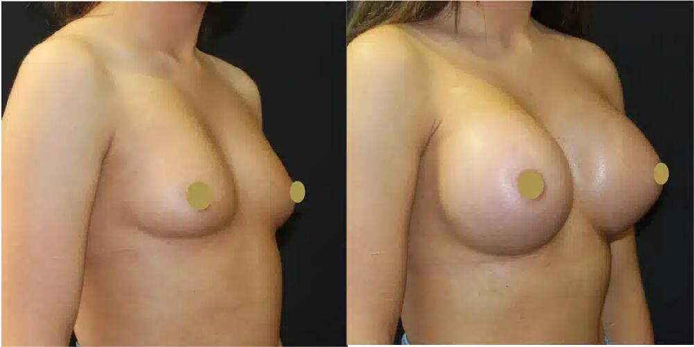 Breast Augmentation Before & After Image