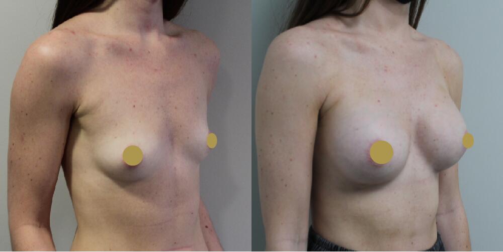 Breast Augmentation Before & After Image