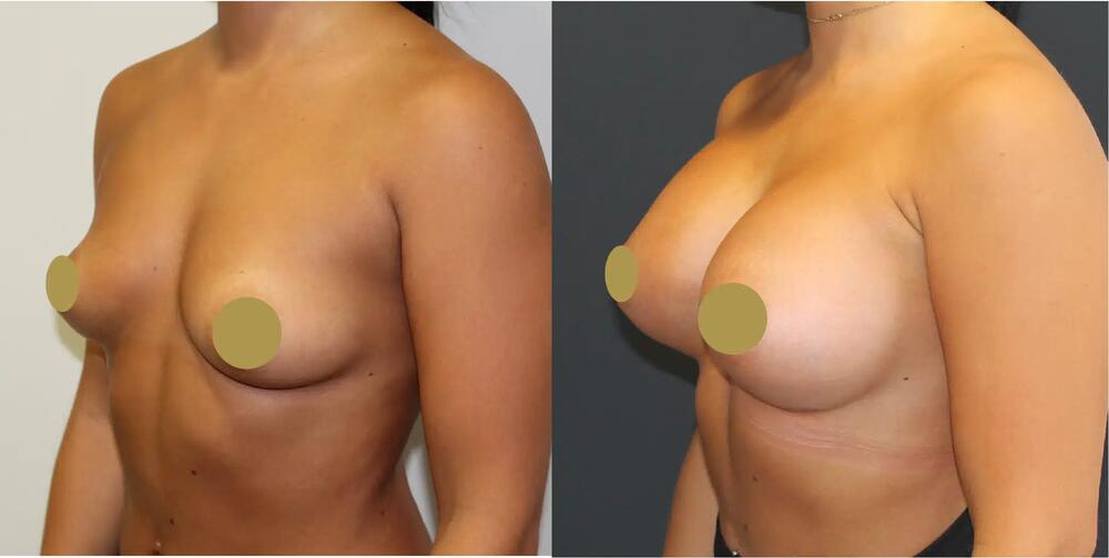 Breast Augmentation Before & After Image