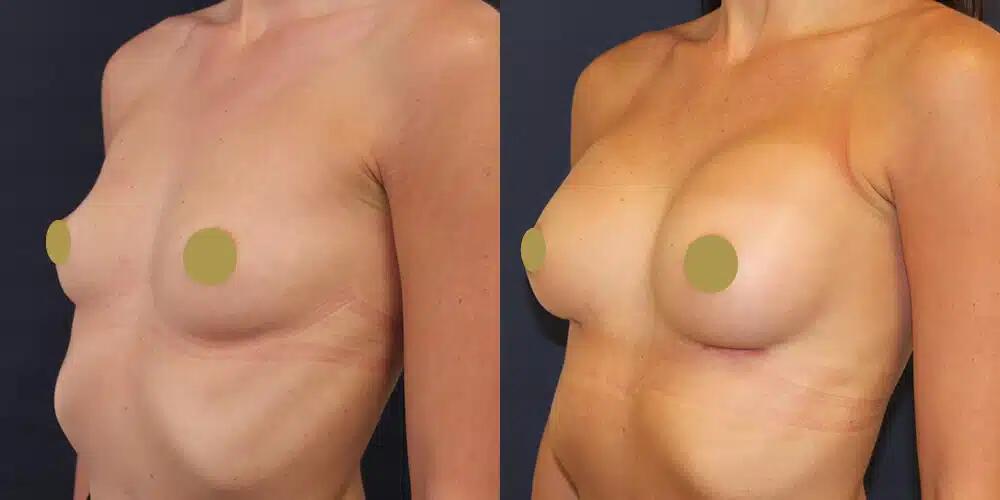 Breast Augmentation Before & After Image