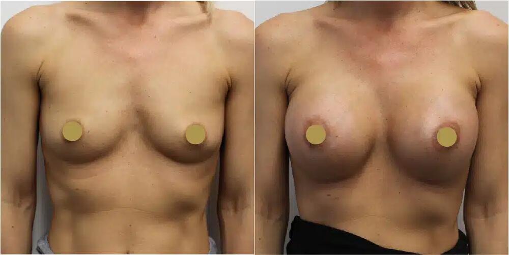 Breast Augmentation Before & After Image