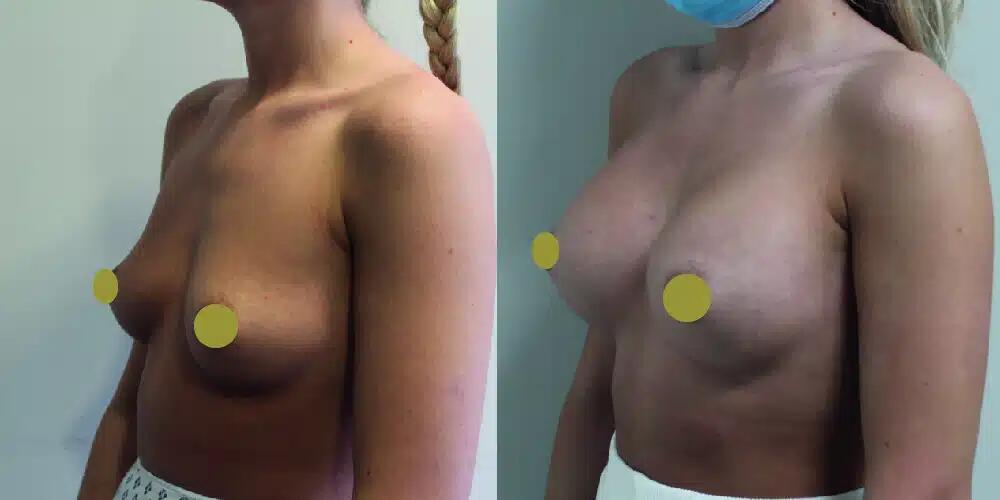 Breast Augmentation Before & After Image