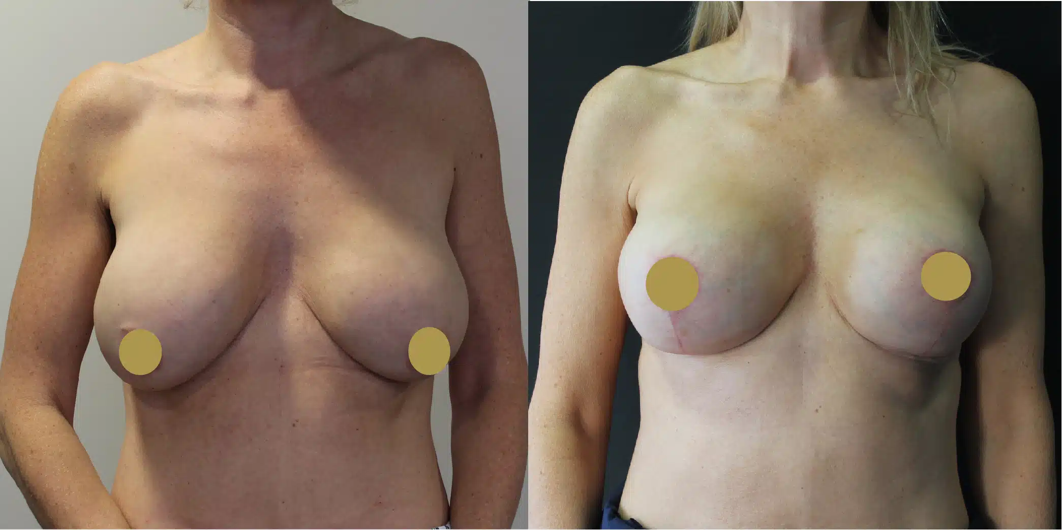 Breast Implant Exchange Before & After Image