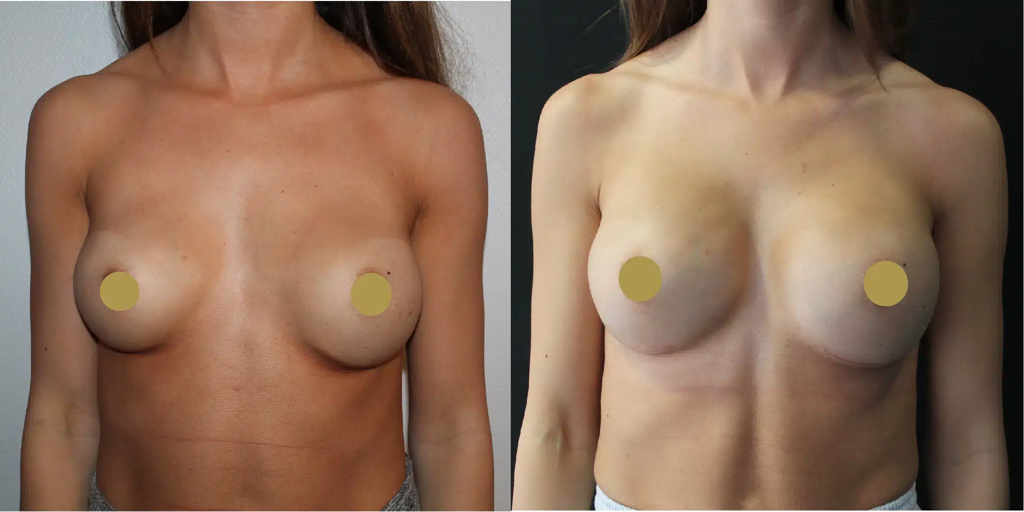 Breast Implant Exchange Before & After Image