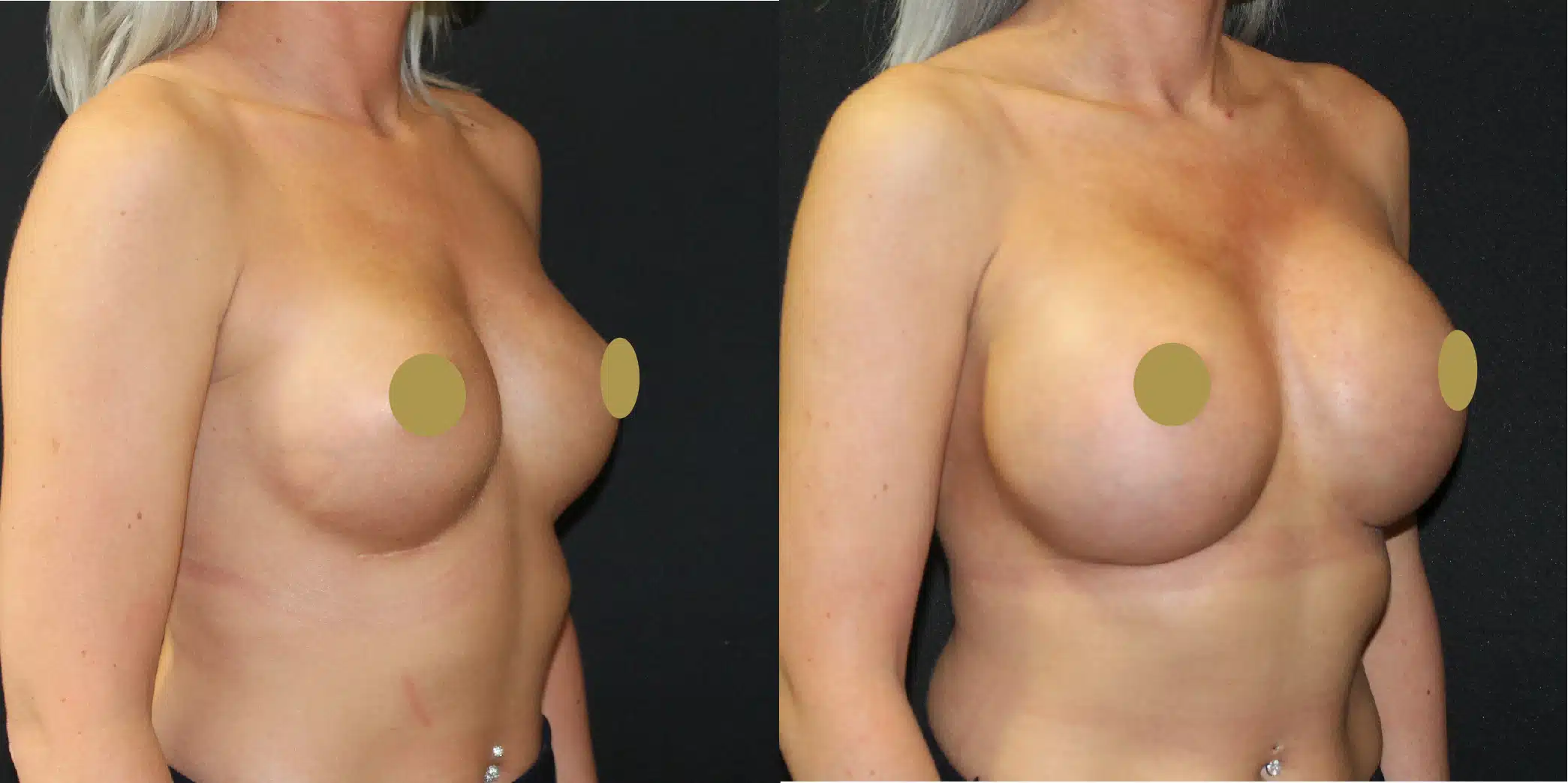 Breast Implant Exchange Before & After Image