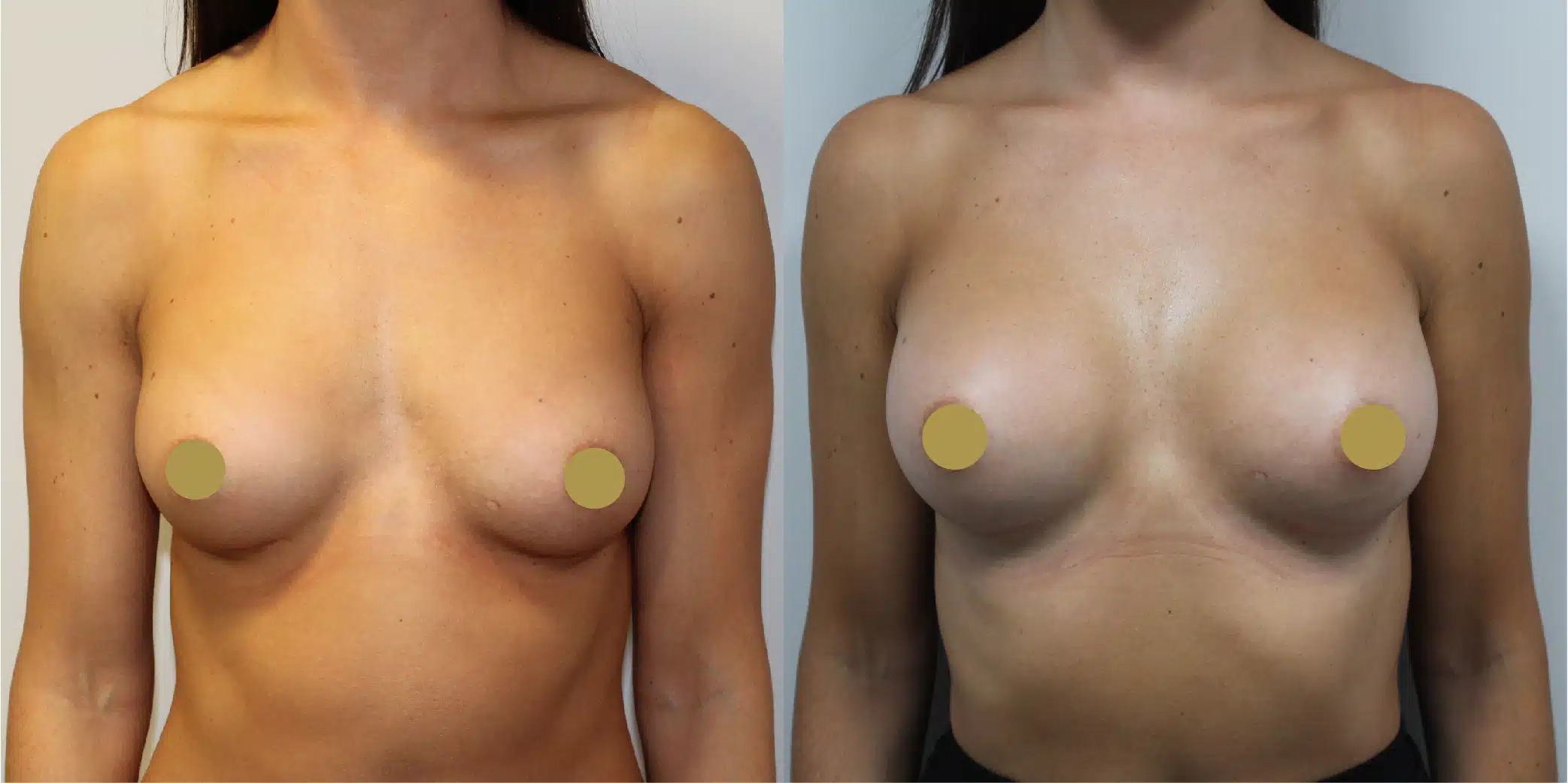 Breast Implant Exchange Before & After Image