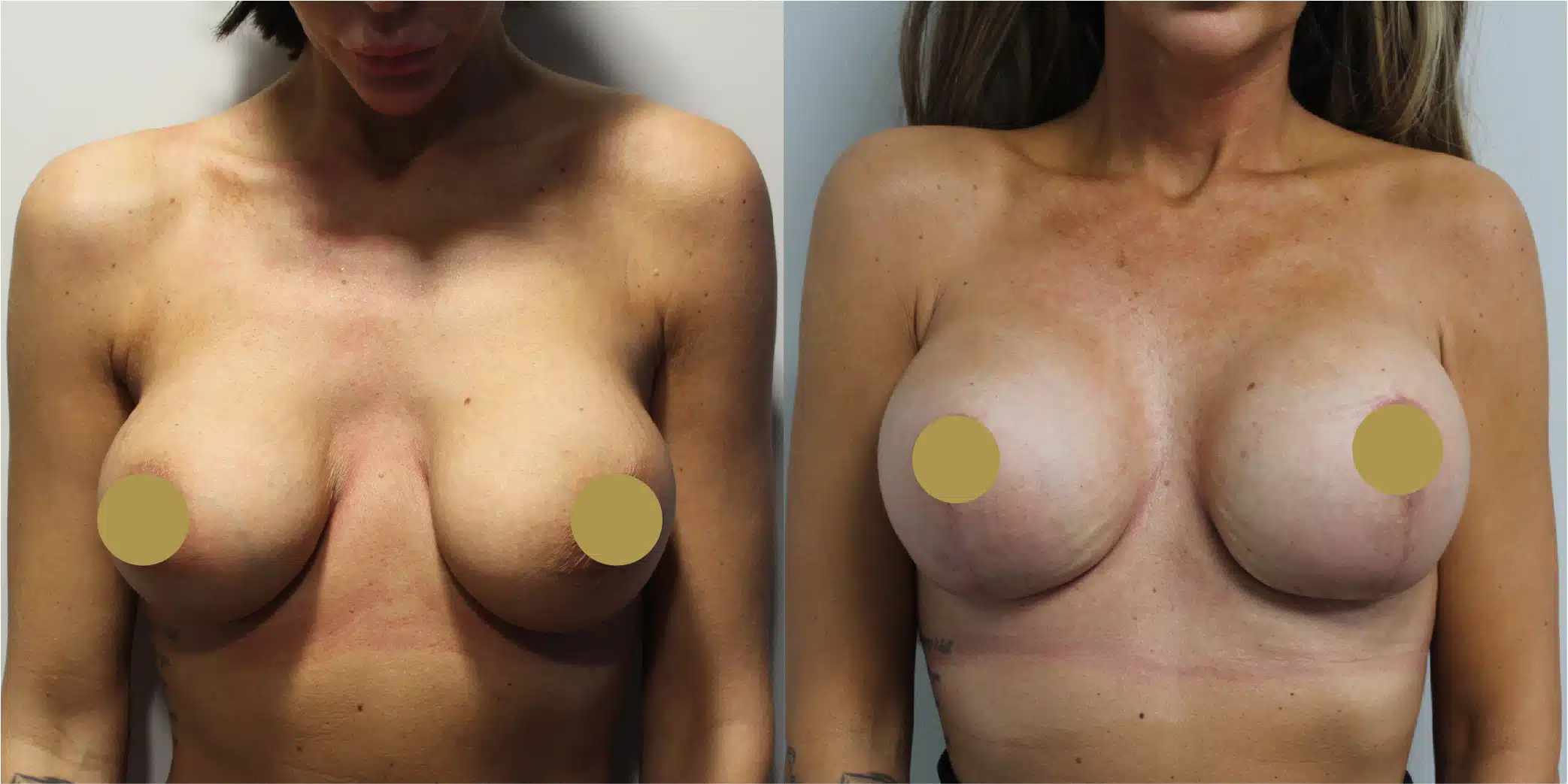 Breast Implant Exchange Before & After Image