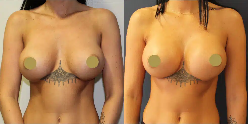 Breast Implant Exchange Before & After Image