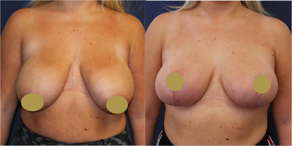 Breast Reduction Before & After Image