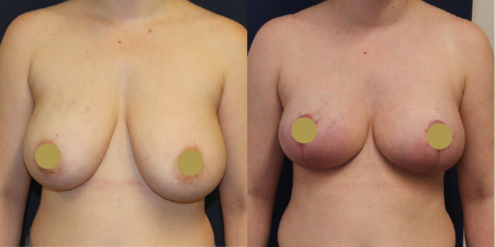 Breast Reduction Before & After Image