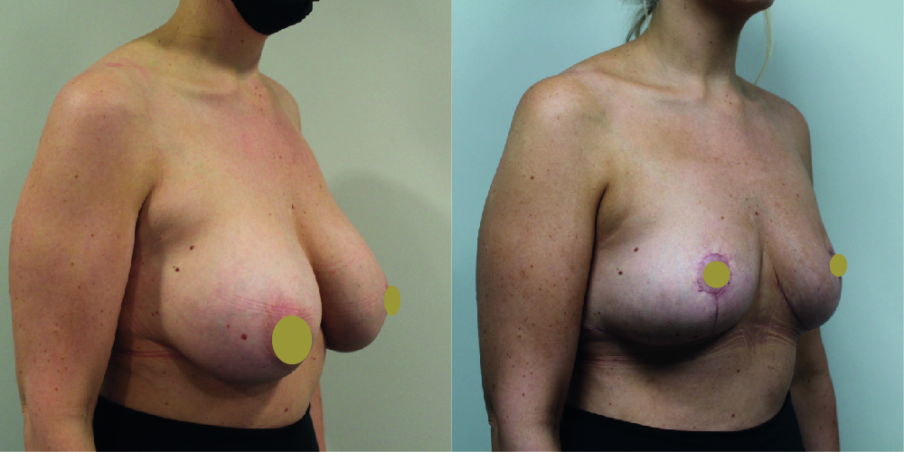 Breast Implant Removal Before & After Image