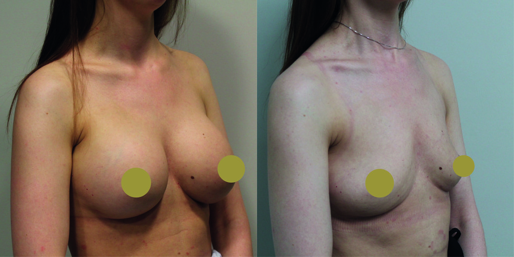 Breast Implant Removal Before & After Image