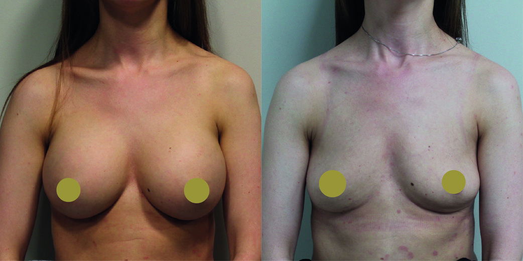 Breast Implant Removal Before & After Image