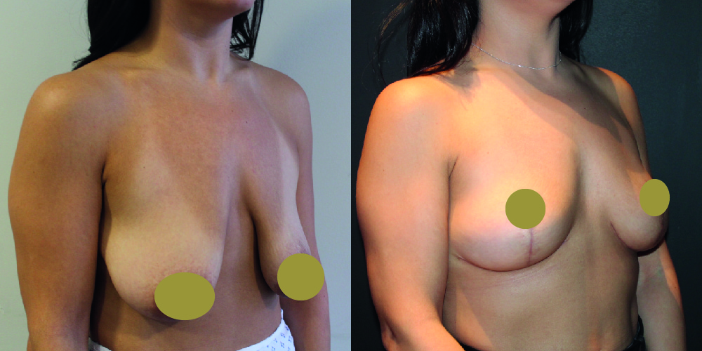 Mastopexy Before & After Image